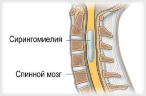 Лечение сирингомиелии в Турции