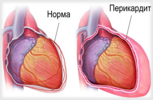 Лечение перикардита в Турции