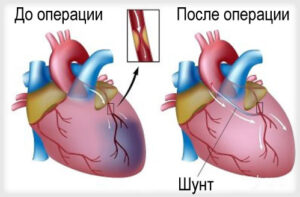Лечение миокардита в Турции