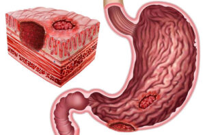 гастродуоденит