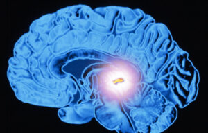 Лечение пинеаломы в Израиле