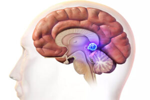 Лечение пинеаломы в Германии