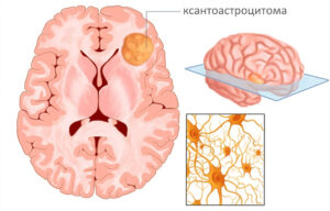Лечение ксантоастроцитомы в Германии