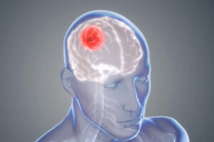 Лечение ксантоастроцитомы в Турции