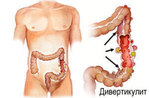 дивертикулит