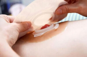 лечение дивертикулита