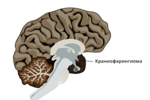 Лечение краниофарингиомы в Турции