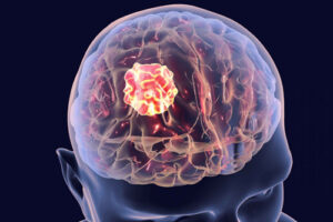 Лечение герминомы в Турции