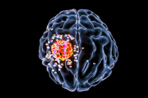 Лечение герминомы в Германии