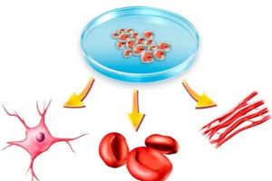 Трансплантация аутологичных стволовых клеток