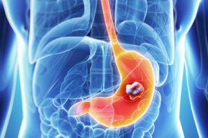 Лечение лимфомы желудка в Германии