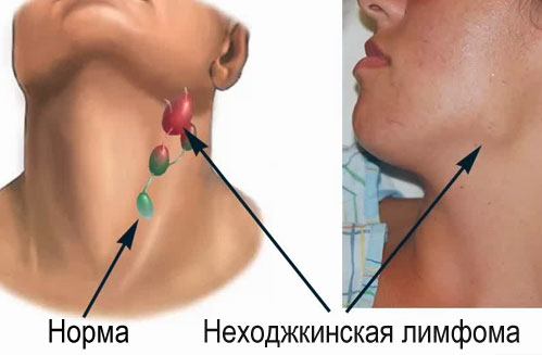 Опухолевые заболевания лимфатических узлов - Комсомольское-на-Амуре подразделение КГБУЗ 