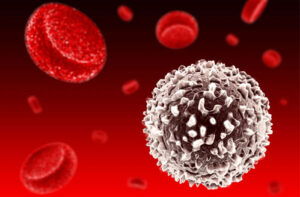 миелобластный лейкоз