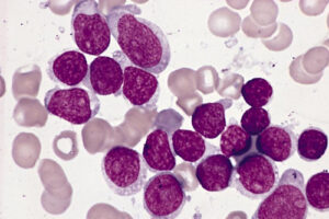 Лечение миелоидного лейкоза в Германии