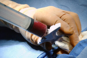 Пересадка костного мозга