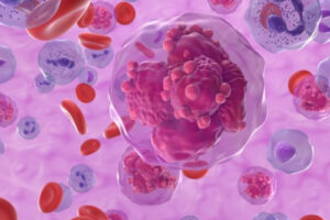 Лечение множественной миеломы в Германии