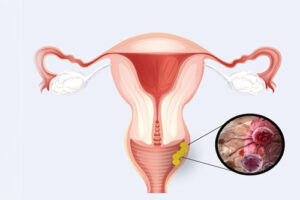 Лечение рака влагалища в Германии