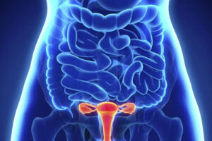 Лечение рака вульвы в Германии