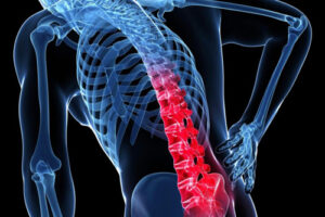 Лечение опухолей позвоночника в Германии