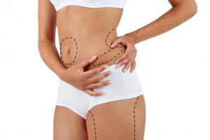 Липосакция в Турции