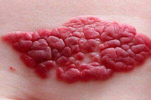 Лечение гемангиомы в Германии