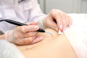 Электрокоагуляция