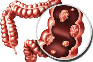 Лечение рака кишечника в Германии