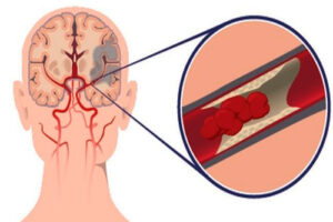 Лечение ишемического инсульта в Германии