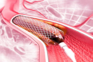 стентирование