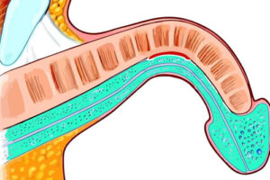 Лечение искривления пениса в Турции