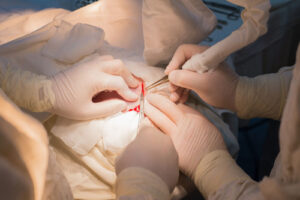 краниотомия