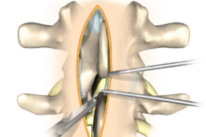 Ламинэктомия