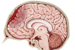 Лечение внутричерепной гематомы в Германии