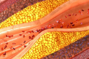 Лечение стеноза сосудов головного мозга в Германии