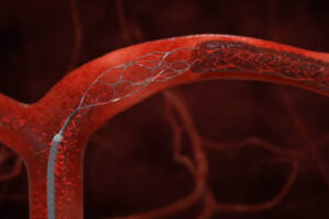 Катетерная механическая тромбэктомия