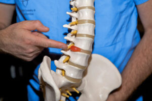 Лечение межпозвоночной грыжи в Германии