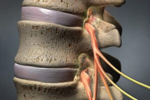 Эпидуральная катетеризация по Рацу