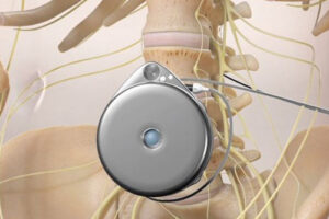 Спинномозговые помпы