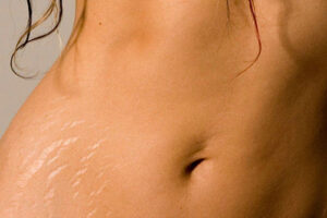 Удаление растяжек в Турции