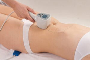 Лазерная шлифовка