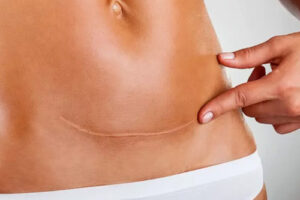 Удаление шрамов и рубцов в Турции