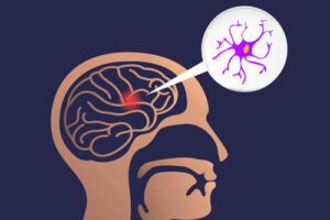 Лечение глиомы хиазмы в Германии