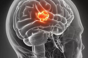 Лечение опухолей центральной нервной системы в Германии