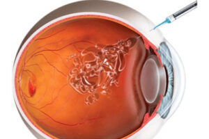 Интравитреальная терапия
