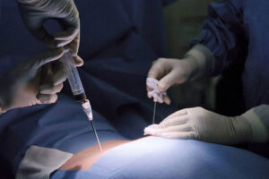 Трансплантация костного мозга или стволовых клеток