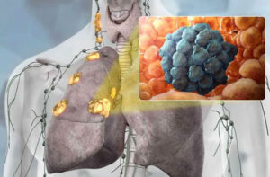 лимфома легкого