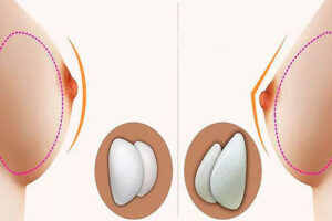 Подтяжка груди с имплантами в Турции