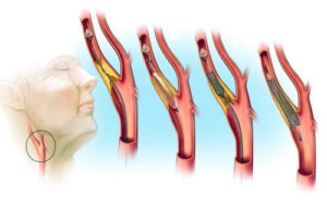 Лечение атеросклероза сонных артерий в Германии