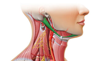 Каротидная эндартерэктомия