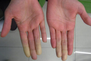 Лечение синдрома Рейно в Германии